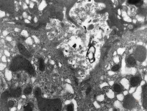 F,3y. | extracellular cholestasis- dilated primary bile duct filled withgranular material